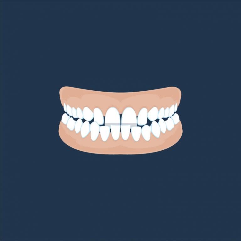 Corinna St Orthodontics Underbite