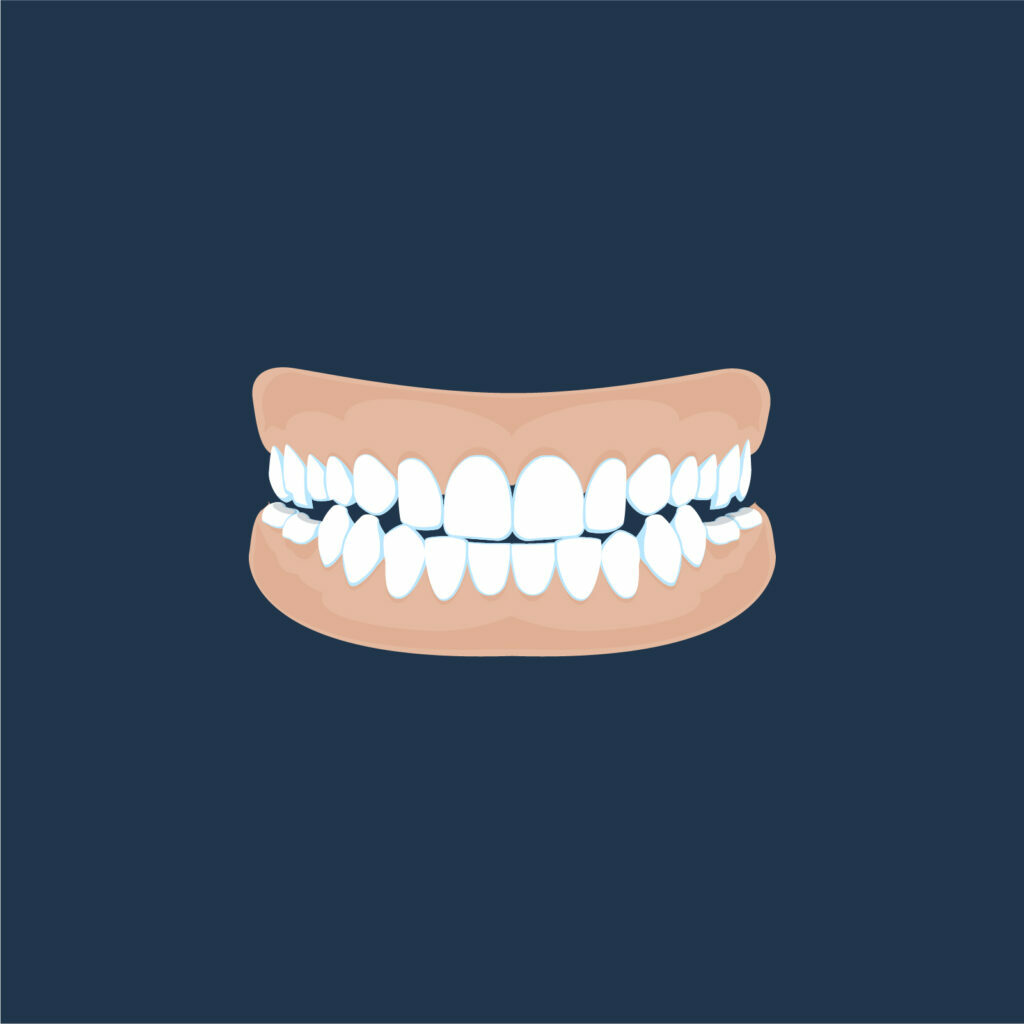 Corinna St Orthodontics Scissor Bite