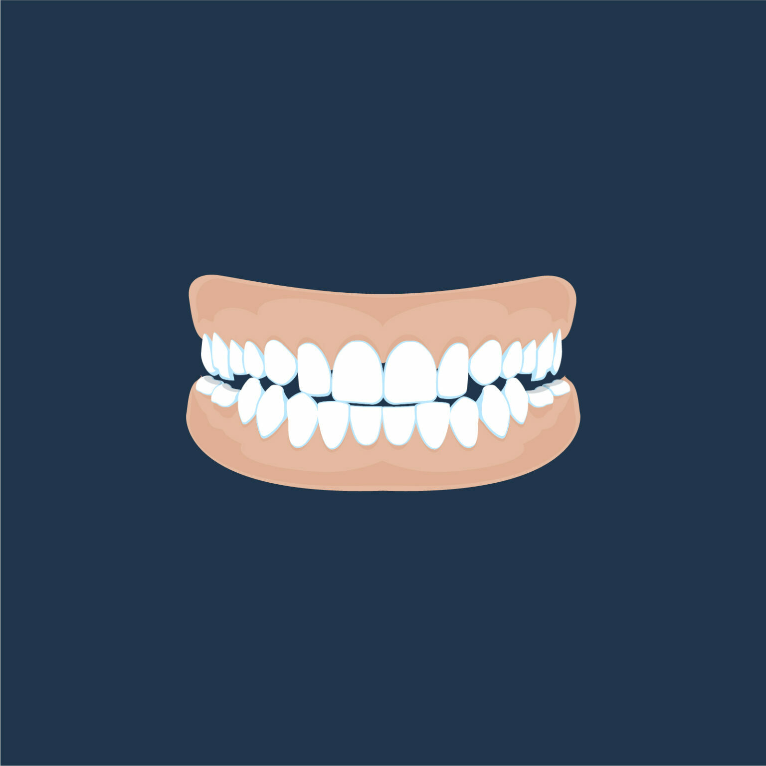 Corinna St Orthodontics Scissor Bite